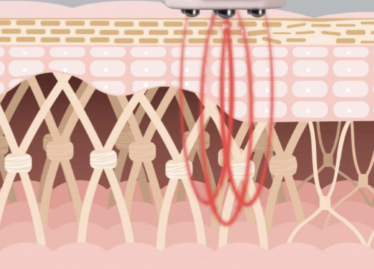 答疑，家用射頻美容儀的6個(gè)常見(jiàn)問(wèn)題