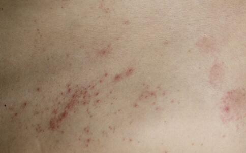 雀斑肌膚愛(ài)&ldquo;吃&rdquo;什么？[3]