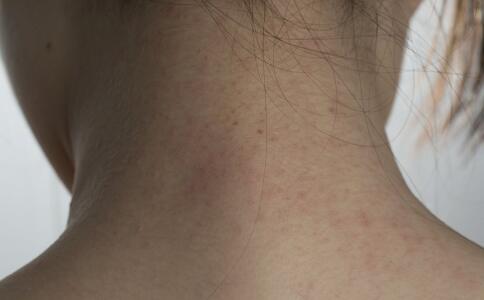 雀斑肌膚愛(ài)&ldquo;吃&rdquo;什么？[4]