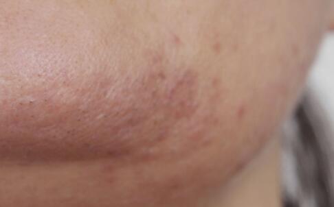 雀斑的常用治療方法