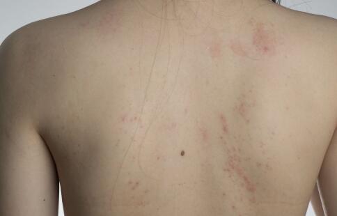 雀斑肌膚愛(ài)&ldquo;吃&rdquo;什么？[2]