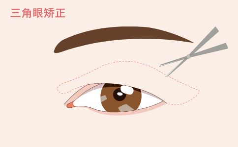 激光祛斑必知四大要點(diǎn)：肌膚煥然一新的秘密武器！