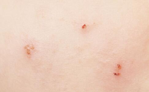 中醫(yī)藥浴美膚奇招！黃褐斑不見了，肌膚煥發(fā)迷人光澤！