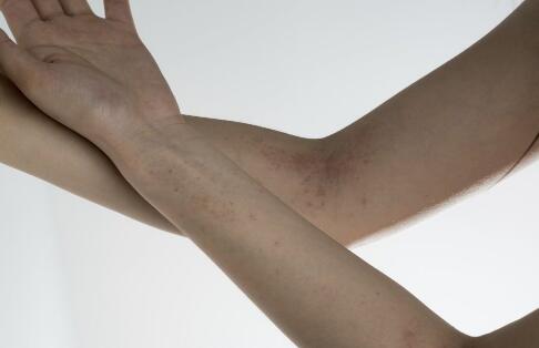 吃出水嫩無(wú)斑肌膚：揭秘十大淡化雀斑的神奇食物，讓你告別雀斑煩惱！