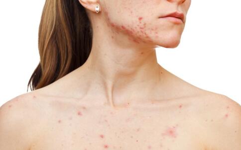 獨家秘笈：輕松祛斑的神奇技巧，讓你重獲無瑕美??！