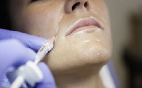 激光祛斑成功的關(guān)鍵：五大注意事項讓你遠(yuǎn)離反彈危機！