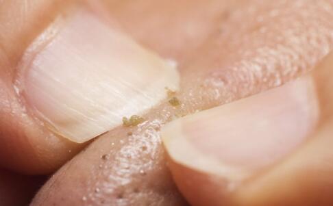 色斑無處藏身：五大神奇方法，讓你擺脫斑點(diǎn)，重拾無瑕美??！