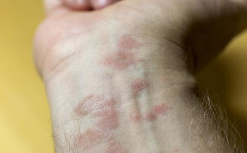 女性兩頰長(zhǎng)斑的原因是什么