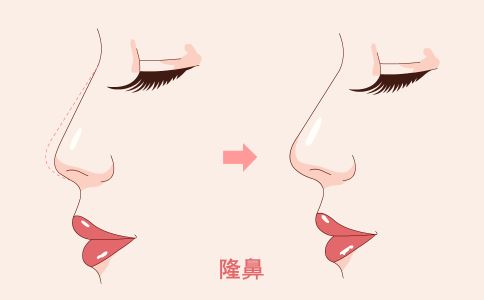 激光祛斑術后如何護理