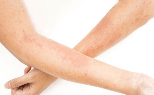 各種色斑的形成原因以及特點