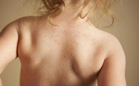 避孕藥可做祛痘用？