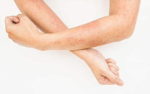 祛痘不可不知的事