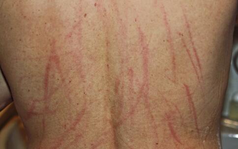 夏日祛痘5大的注意事項(xiàng)