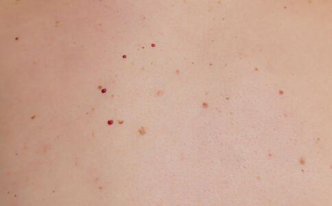 逗MM最愛的8款祛痘產(chǎn)品