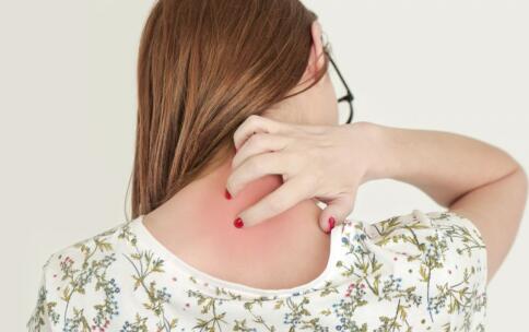 祛痘特有效的4錦囊