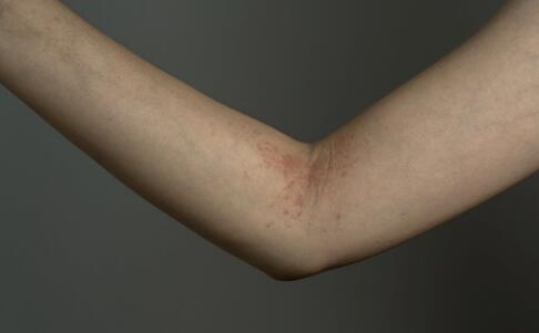 后背長(zhǎng)痘痘怎么辦 正確的祛痘的步驟