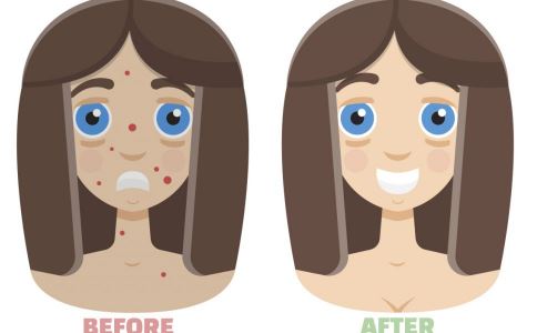 去痘印小妙招 細(xì)數(shù)生活中的祛痘秘訣