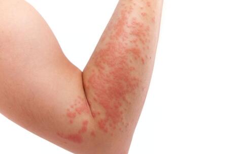 推薦:治療黃褐斑的幾款面膜