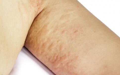 最常用四種去除魚尾紋方法