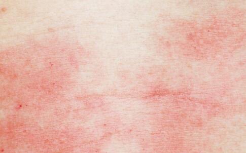 除皺針的副作用有哪些 7個妙招安全除皺